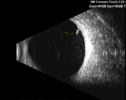 Ecografí­a Ocular A-B