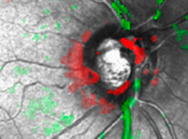 Topografí­a de Nervio óptico