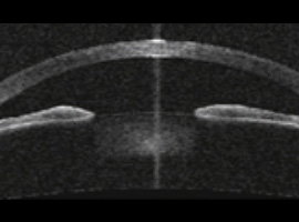 Ultrabiomicroscopí­a (UBM)